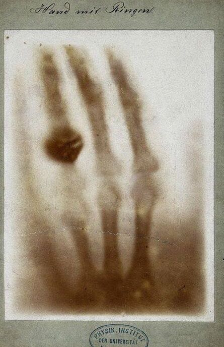 The First X-Ray